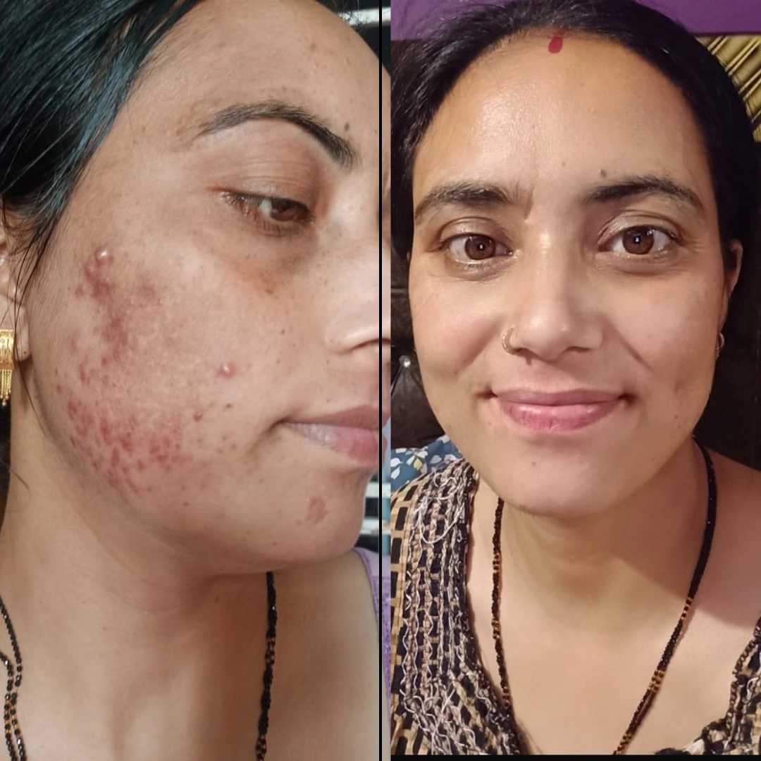 Dipika, before and after